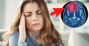 The word is from greek: Aneurisma Cerebral Cuando El Dolor De Cabeza Te Puede Llevar A Un Sueno Eterno