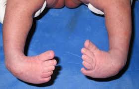 In some children, clubfoot deformity occurs as a symptom of another disorder. Clubfoot In Babies And Children