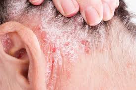 Rash Behind The Ear 5 Causes And Treatments Vitamins For Psoriasis Psoriasis Treatment Natural Psoriasis Treatment
