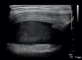 Image result for Knee Bulge Sign