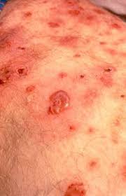This prevents the removal of waste, and when this happens, it can give rise to. Henoch Schonlein Purpura Johns Hopkins Vasculitis Center