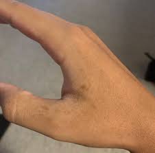 Brown and orange spots and stripes on black background. Patch Of Small Brown Spots Developing On My Hand Imgur