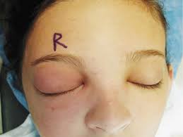 Ein Ratselhafter Patient Abzesse Im Kopf Und Rachenraum Der Spiegel