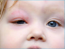 Diagnosis, management and treatment of orbital and periorbital cellulitis  in children