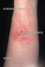 Image result for Rhus Dermatitis