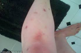 Besides being unsightly, ingrown hair scars can be painful, irritating and hard to treat. I M Addicted To Plucking Woman 27 Left Scarred For Life After Pulling Hairs From All Parts Of Her Body Daily Mail Online
