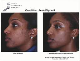 Some parts of the skin become darker compared to the immediate surrounding skin. Atlanta Acne Pigment Before After Photos