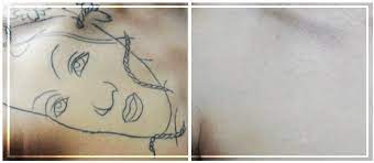 These 4 are the best surgical methods to remove permanent tattoos with this method is most often used to remove skin cancers and warts but it's also used in tattoo removal. Picosecond Lasers Meeting Advanced Tattoo Removal And Changing Demographics Needs Modern Aesthetics