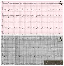 Image result for Flecainide Overdose