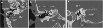Image result for Ossicular Chain Disruption