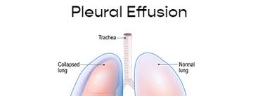 Information and translations of effusion in the most comprehensive dictionary definitions resource on the web. Pleural Effusion Causes Symptoms And Treatment Netmeds