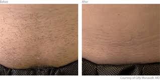 There's a science bit too with detail you won't find anywhere else! Lumenis Laser Hair Removal In Wandsworth Earlsfield Putney Clapham Battersea