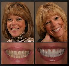 Tooth-Colored Fillings Rochester, MI