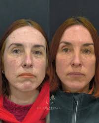 Resultado real do nosso protocolo TricoHealth! Cabelos mais cheios,  saudáveis e com crescimento visível já nas primeiras semanas. Essa  transformação é fruto de um tratamento personalizado que age na causa da  queda