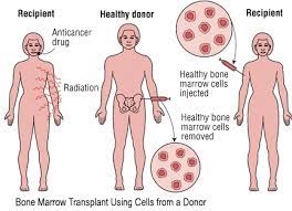 What Happens During A Bone Marrow Transplant Ask Doctor K Tủy Xương Chua Co Dau