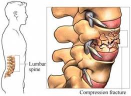 Main chain or backbone that linear chain to which all other chains, long or short or both, may be regarded as being pendant. Lumbar Spine Fracture Physiopedia