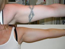 However, you should consider these factors in your decision: Tattoo Removal Laser Skin Care Santa Rosa Artemedica