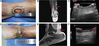 Image result for Probe-to-Bone Test