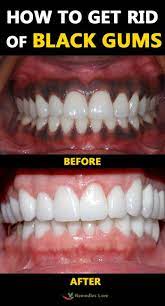 How To Get Rid Of Black Gums Blackgums Gums Https Www Remedieslore Com How To Get Rid Of Black Gums Black Gums Gum Treatment Gum Health