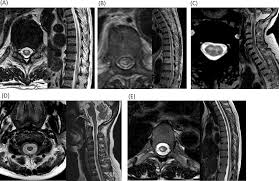 They most commonly affect elderly men and are classically found in the thoracolumbar region. A Comparison Between Spinal Cord Infarction And Neuromyelitis Optica Spectrum Disorders Clinical And Mri Studies Scientific Reports