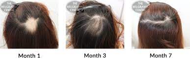 The american academy of dermatology suggests it is normal to lose 50 to 100 hairs each day. Can Losing Weight Return Grey Hair To Its Natural Colour