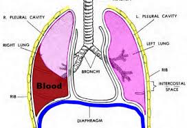 Image result for Hemothorax