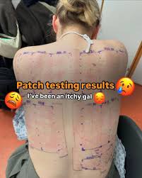 Image result for Patch Testing