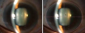 Image result for Lens Dislocation