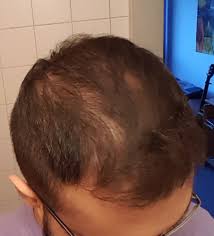 Keep reading to see more about it. Dutasteride Hairlosstalk Dutasteride 6 Month Results