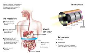 Image result for Wireless Capsule Endoscopy