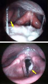 Did you found this helpful? Voice Swallowing Problems Disorders Ohsu