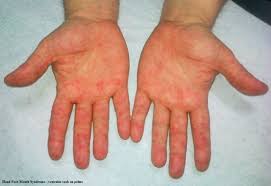 Some research suggested that adults and older children have a milder form of the disease but that was not my case. Hand Foot And Mouth Syndrome In An Immunocompetent Adult A Case Report Bmc Research Notes Full Text