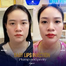 BABY LIPS INJECTION Achieve plump, pretty lips with a heart-shaped design  💗 👉Forget about uneven lip shapes, thin lips, etc. Let the doctors at  Gangwhoo Hospital transform your lips to become more
