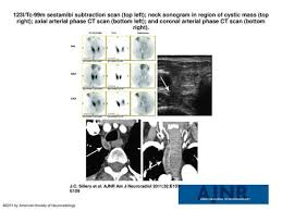 Thoracolumbar Spine Amyloidosis In A 54 Year Old Woman With Back Pain For A Few Months Duration Thoracolumbar Spine Amyloidosis In A 54 Year Old Woman Ppt Download