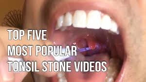 Gargling with salt water regularly is one of the best ways to prevent tonsil stones. How To Tonsil Stones Removal Everything Explained Step By Step