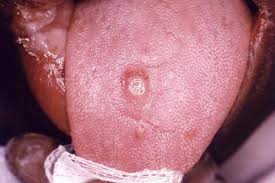 الزرافة لها لسان طويل فكم طوله؟. Ø§Ù„Ø²Ù‡Ø±ÙŠ ÙÙŠ Ø§Ù„Ù„Ø³Ø§Ù† Ø§Ù„Ø£Ø¹Ø±Ø§Ø¶ ÙˆØ§Ù„Ø¹Ù„Ø§Ø¬