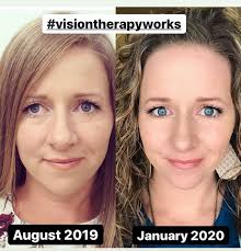 Strabismus Meets Vision Therapy Vision Therapy Lazy Eye Exercises Strabismus Exercises