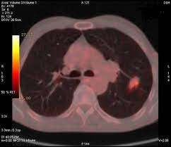 When people with lung tb cough, sneeze or spit, they propel the tb germs into the air. Tuberculosis Mimicking Lung Cancer Sciencedirect