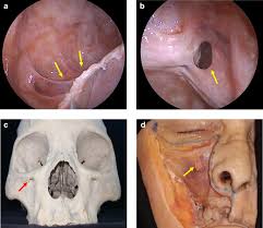 Image result for Maxillary Sinus