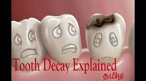 How are home remedies help prevent tooth decay? How To Clean Cavity Teeth At Home In Tamil Herunterladen
