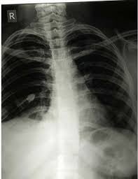 Patients with a pneumothorax typically report dyspnoea and chest pain. Right Side Recurrent Pneumothorax Download Scientific Diagram