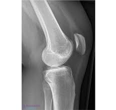 Image result for Knee XRay