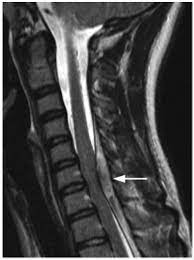 Emdocs Net Emergency Medicine Educationspinal Epidural Hematoma Emdocs Net Emergency Medicine Education