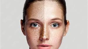 Image result for Freckled skin