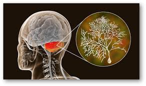 Image result for Essential Tremor