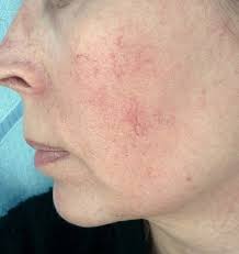 как избавиться от белых пятен на лице в домашних условиях Kuperoz Na Lice Chto Nuzhno Delat I Chego Izbegat Pri Sosudistoj Setke Lico Lekarstva Dlya Kozhi Uhod Za Licom
