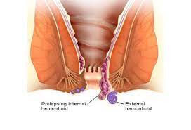 Remember, to help treat and prevent hemorrhoids it's important to eat enough fiber (25 grams a day for women, 38 grams a day for men) and to drink at least eight glasses of water a day. Internal And External Hemorrhoids Symptoms Treatment Pictures Causes