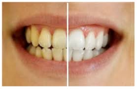 How to reverse gum disease at home. Periodontal Disease Perio Protect Clarkston Mi