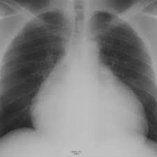 La pericardite una malattia infiammatoria del pericardio, la sottile membrana che avvolge il cuore, e può essere presente anche senza coinvolgimento miocardico o endocardico. Pericardite Disturbi Dell Apparato Cardiovascolare Manuali Msd Edizione Professionisti