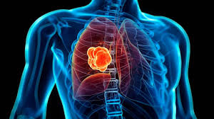 Resultado de imagen de carcinoma de pulmon